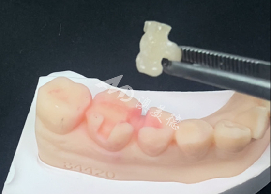 खरीदें प्राकृतिक दांत रंग और आसान रखरखाव के लिए ईमैक्स सिरेमिक इनलेस ऑनलेस डेंटल रिस्टोरेशन online manufacture