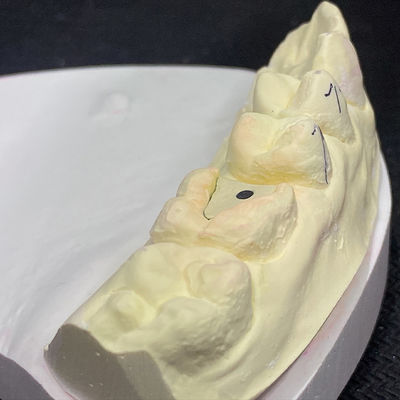 खरीदें लॉक पिंक पोस्ट कोर टेक्नोलॉजी के साथ अपने पुनर्स्थापना को मजबूत करें online manufacture