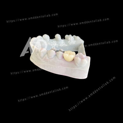 खरीदें पीएफएम मैरीलैंड ब्रिज वन पोंटिक टू विंग्स एक रूढ़िवादी और सौंदर्य समाधान online manufacture