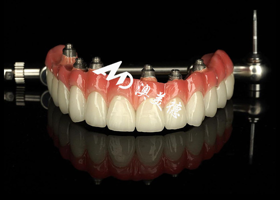 अच्छी कीमत अनुकूलित दंत प्रत्यारोपण समर्थित दांत Crown Bridge For Missing Teeth Maintenance ऑनलाइन