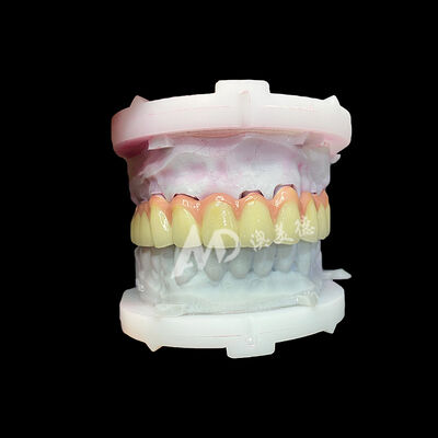 अच्छी कीमत शुद्ध टाइटेनियम सिरेमिक मुकुट और पुल टिकाऊ हल्के सौंदर्य पुनरुद्धार ऑनलाइन